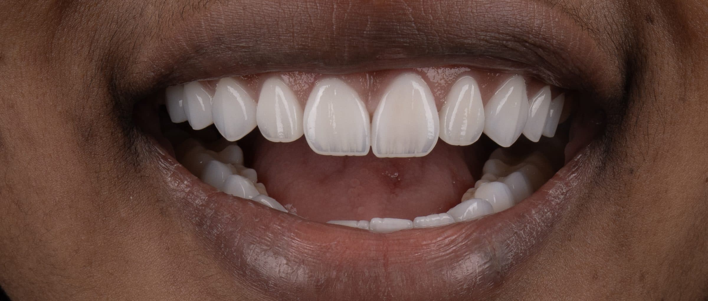 Smile makeover, after treatment at Pure