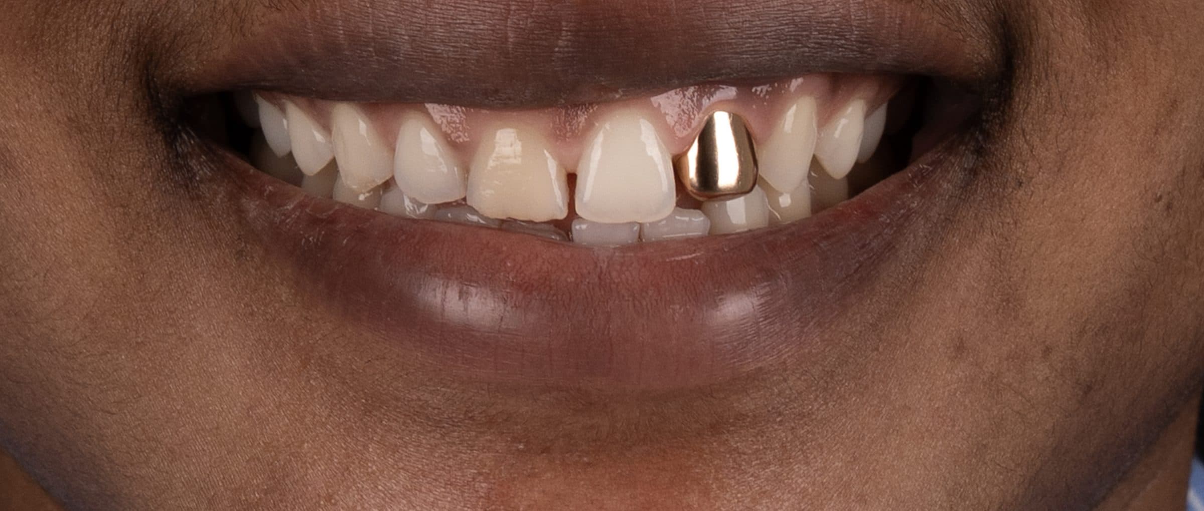 Smile makeover, before treatment