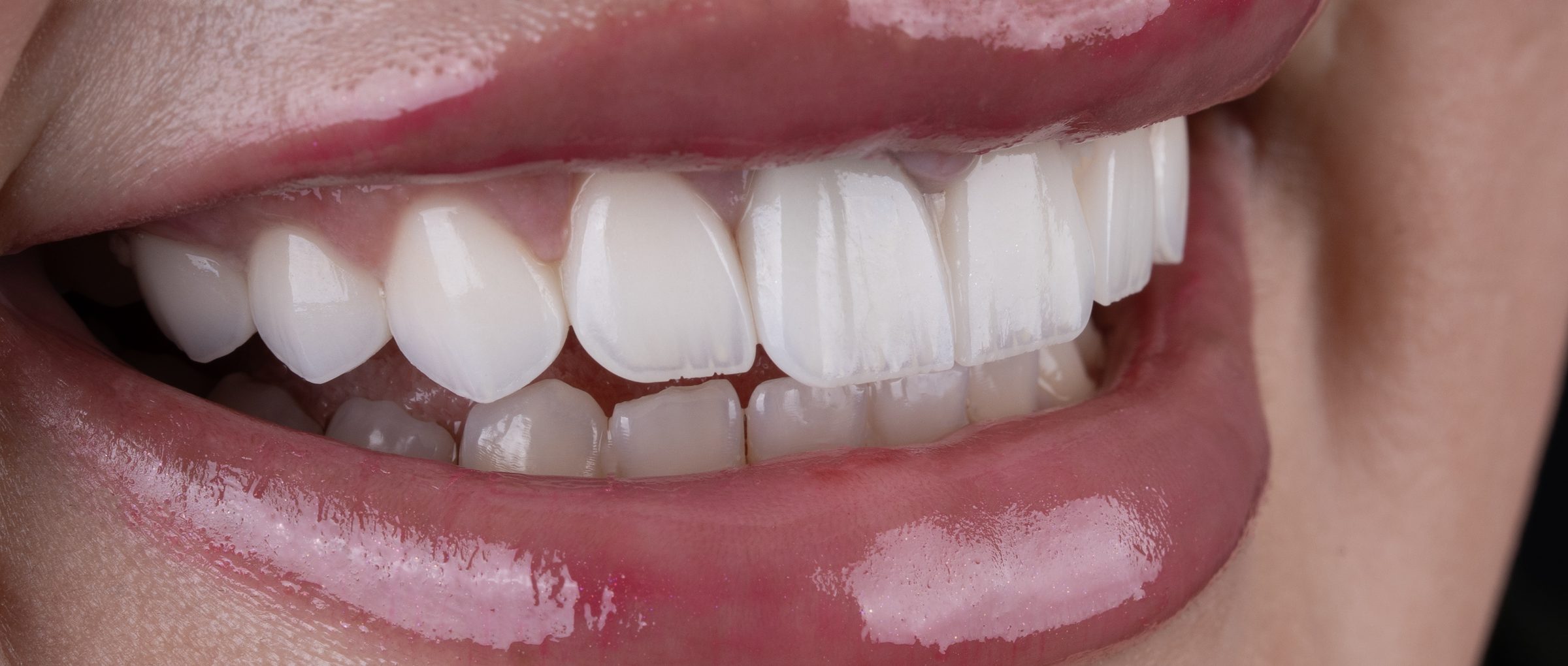 Veneers, after treatment at Pure