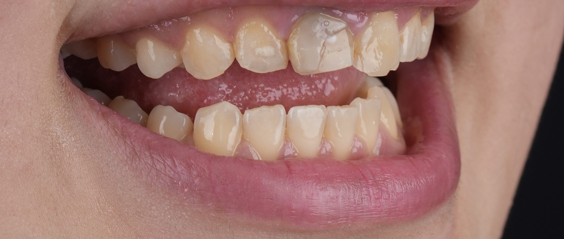 Veneers, before treatment