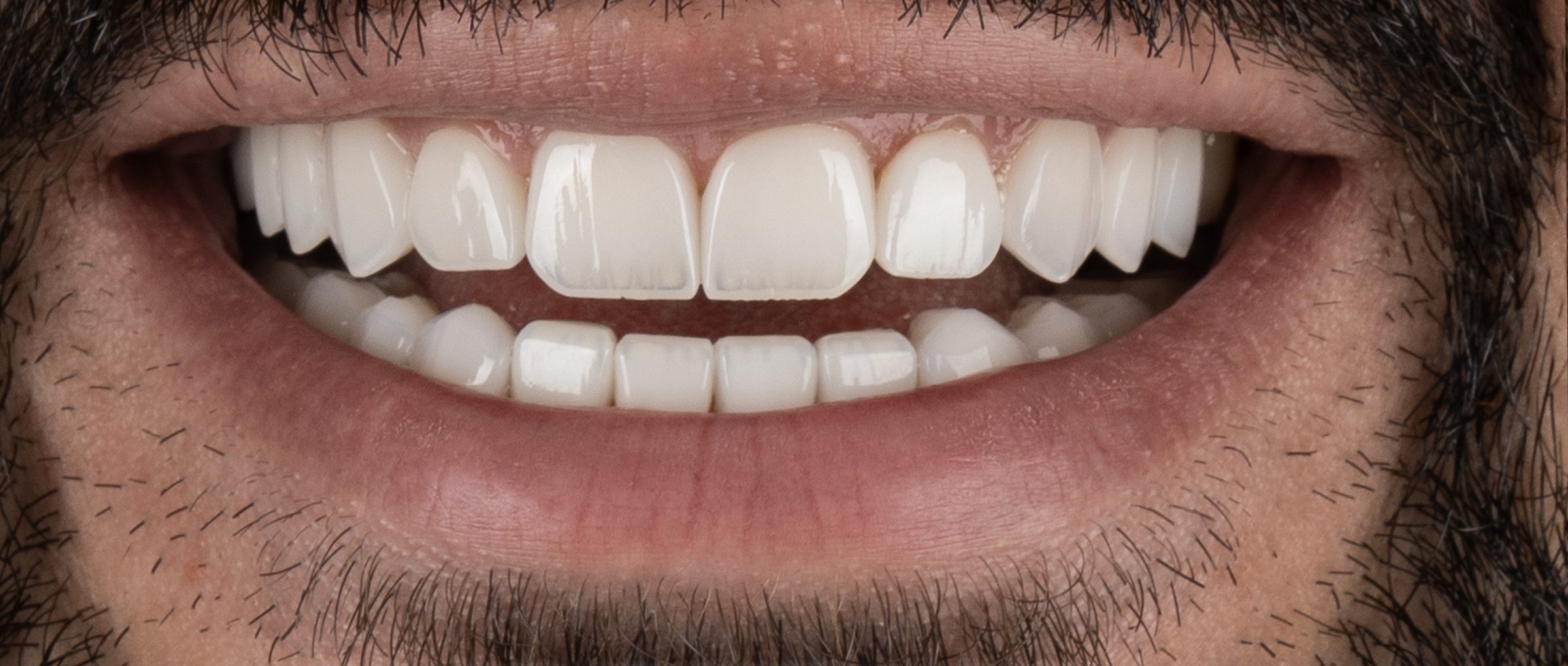 Smile design, after treatment at Pure