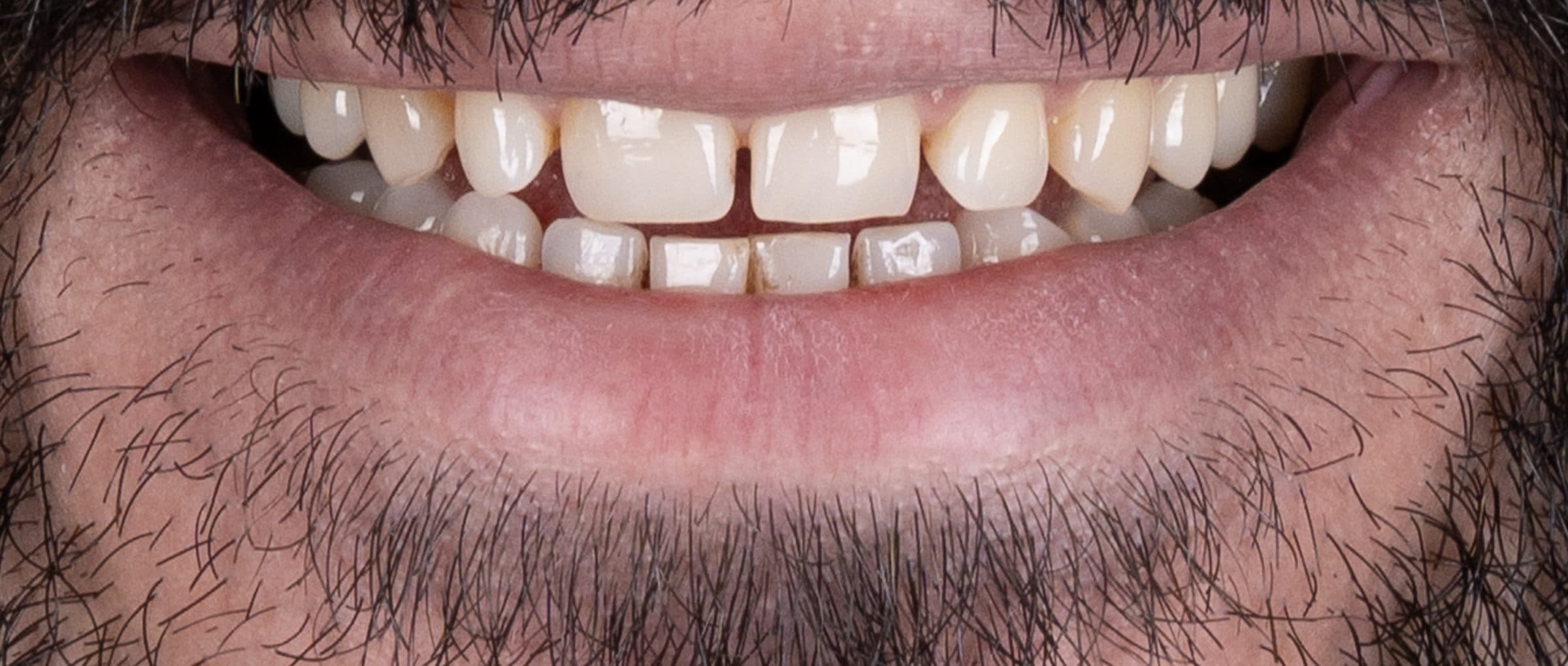 Smile design, before treatment