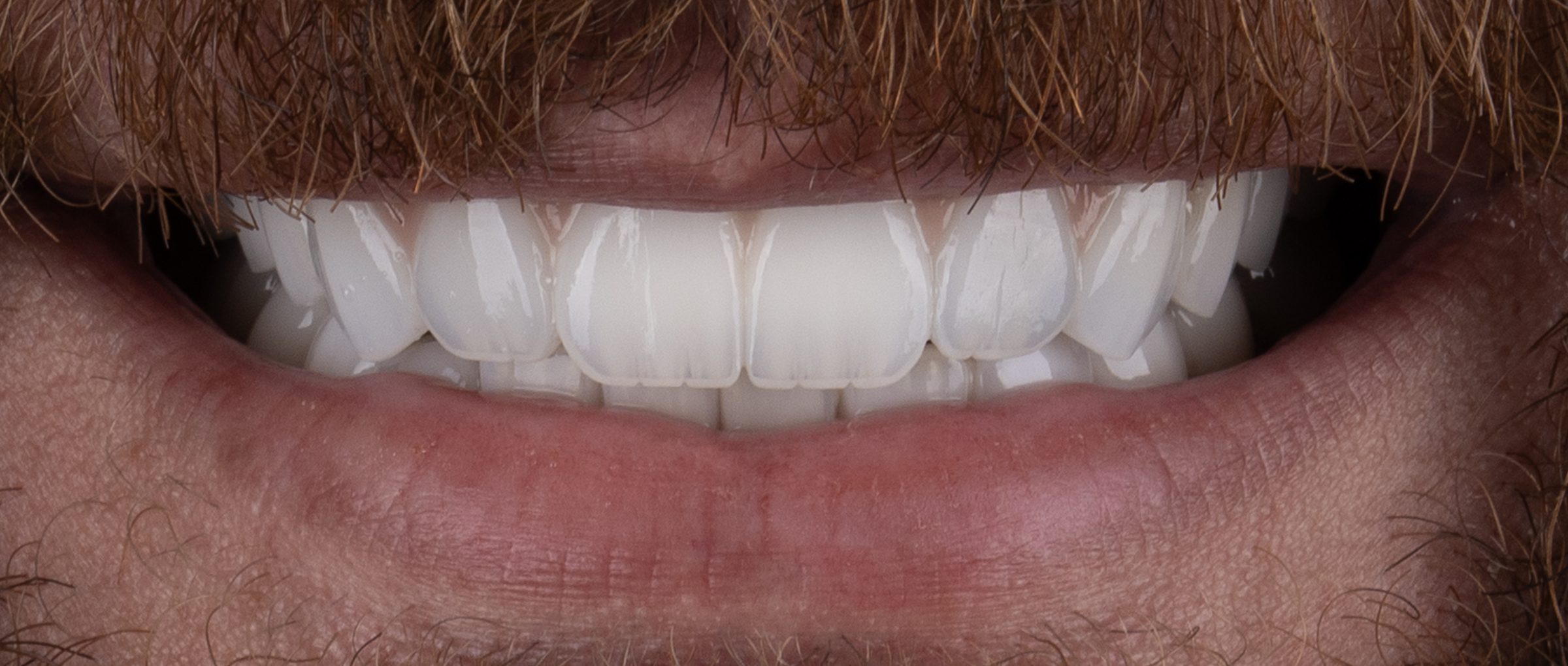 Whitening & contour, after treatment at Pure