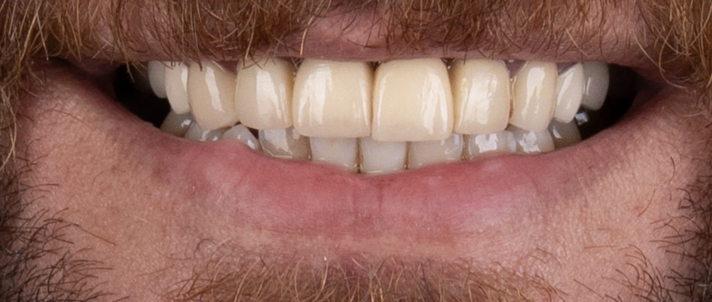 Whitening & contour, before treatment
