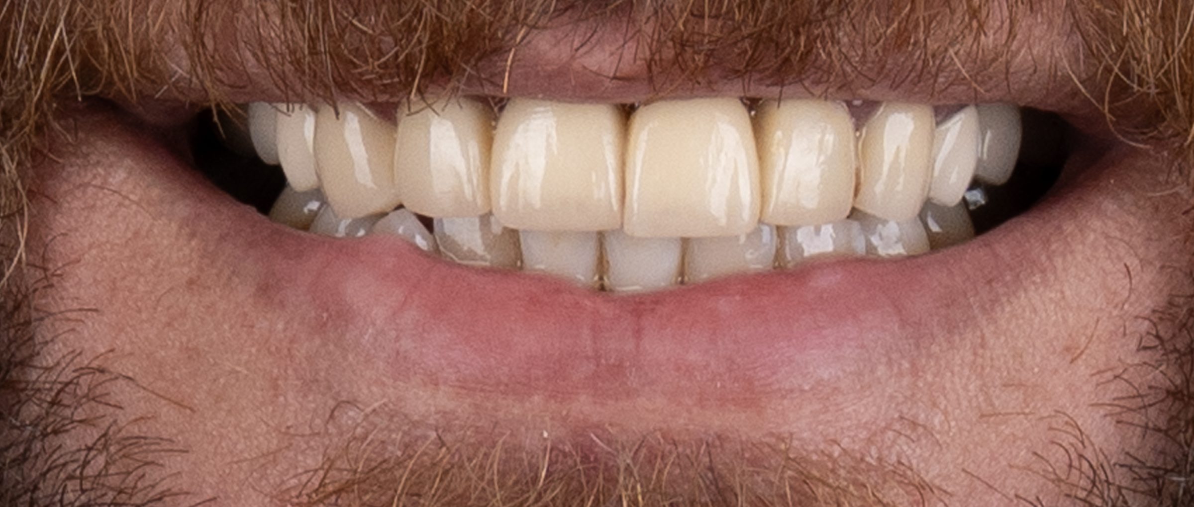 Whitening & contour, before treatment