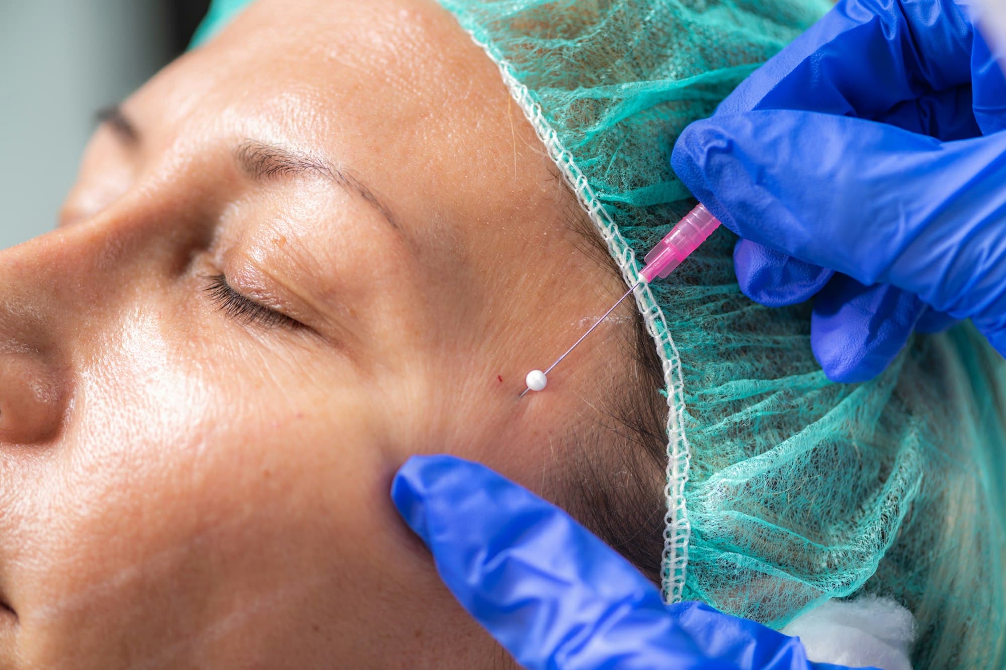 A facial aesthetic procedure